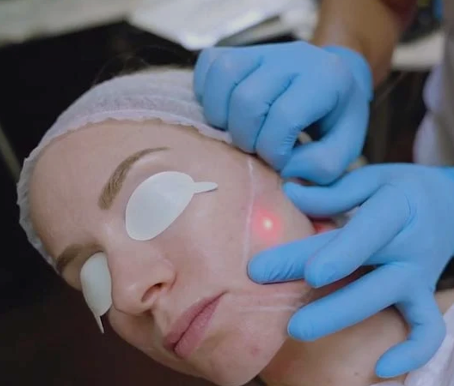 Endolift® Laser-lankahoidon