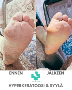 Hyperkeratoosi, syylä hoito