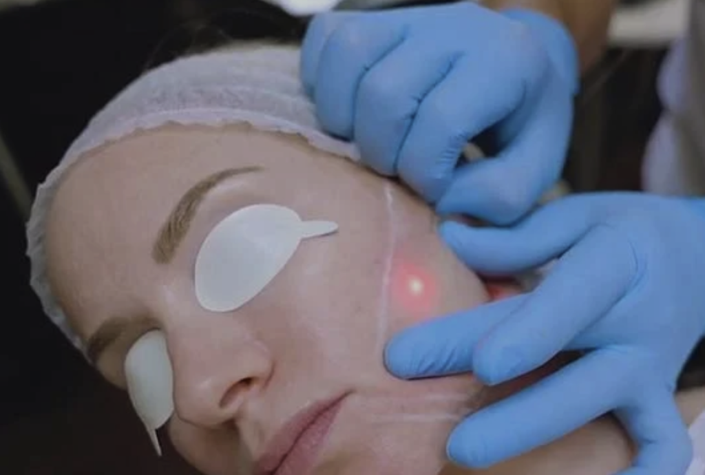 Endolift® Laser-lankahoidon